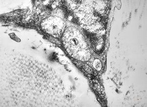 M, 10y. | Coffin-Lowry syndrome - skin M, 10y. | Coffin-Lowry syndrome - skin